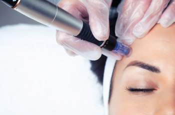 Can Lactic Acid Be Used After Microneedling?