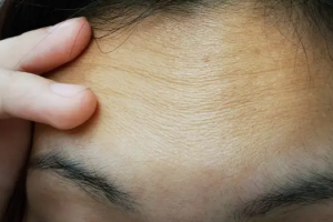 How to Reduce Forehead Wrinkles?