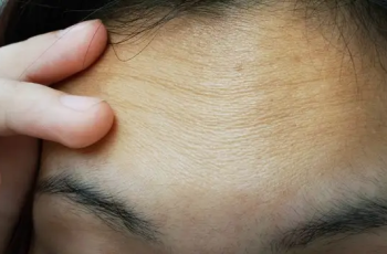 How to Reduce Forehead Wrinkles?