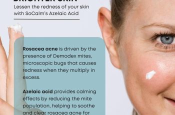 What Does Azelaic Acid Do for Rosacea