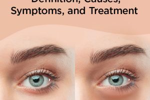 What are the causes of puffy eyes and how to get rid of it