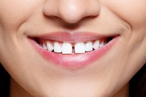 Diastema- The Powerful Tooth-Gap Elfenbeinhandel