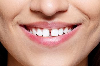 Diastema- The Powerful Tooth-Gap Elfenbeinhandel