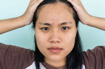 Ask the Dermatologist 4 Lies You’ve Been Told About Acne