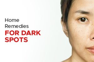 What Skin Care Tips Can Help You Manage Dark Spots