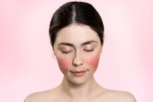 Can I Use Retinol for Rosacea?