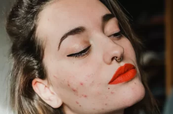 Cheek Acne 101: The causes and remedies of home-based acne.