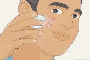 How to get rid of pimples?