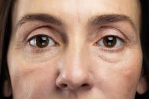 What causes puffy eyes and how to get rid of puffy eyes?