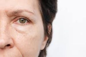 What causes puffy eyes and how to get rid of them?