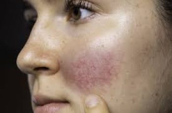 What Does Azelaic Acid Do for Rosacea?