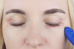 What is ocular rosacea? Symptoms and causes of ocular rosacea