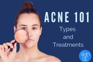 Which components facilitate the clearance of acne?