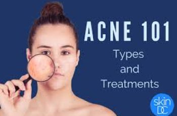 Which components facilitate the clearance of acne?