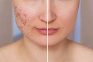 Acne Scar Fillers: Everything You Need to Know About Minimally Invasive Treatments