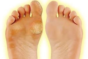 How to Get Rid of Calluses on Feet Naturally?