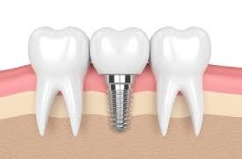 How to Keep Your Dental Implants in Good Condition