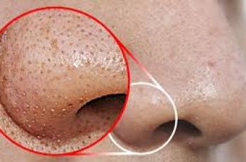 How to remove blackheads on nose?