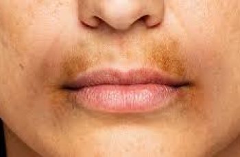 How to fight hyperpigmentation around the mouth?