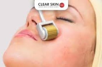 Microneedling Roller for Acne Scars: 7 Best Microneedling Rollers for Intensive Acne Scar Treatment.