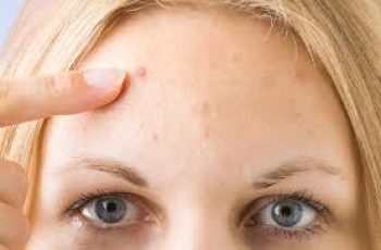 Ask the Dermatologist: Should I Pop Pimples or Avoid Them?