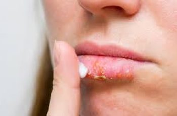 Chapped Lips vs. Cold Sores: How to Know What You’re Dealing With