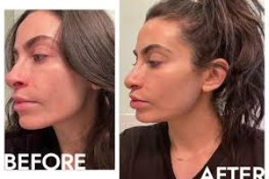 I Tried AviClear — A New Acne Laser Treatment — And It Made a Huge Difference