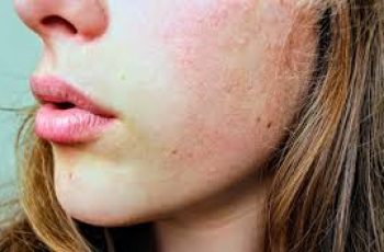 What Causes Dry Patches On Your Face?