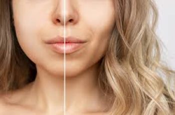 What Is Buccal Fat Removal? What to Expect With the Cosmetic Procedure