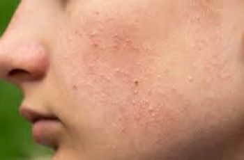 Fungal Acne Could This Be Causing Your Persistent Pimples