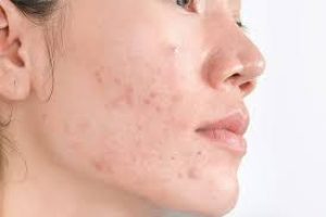 Inflammation Causes Hyperpigmentation