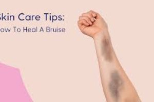 Skin care Tips : How to Heal a Bruise