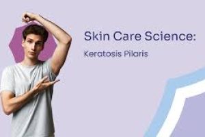 The Science of Keratosis Pilaris (Chicken Skin)