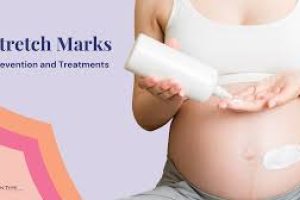 Stretch Marks: Prevention and Treatment