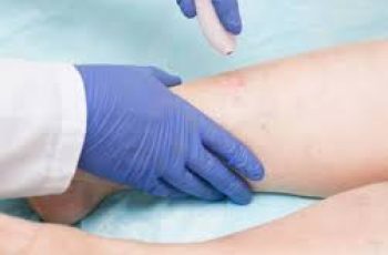 What Is Sclerotherapy?