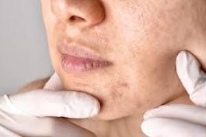 What Causes Clogged Pores and Comedones?