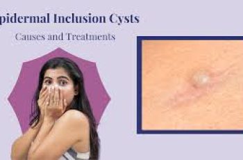 Epidermal Inclusion Cyst