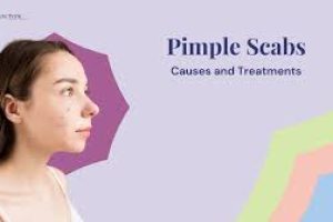 Pimple Scab: How to Heal Acne Scabs