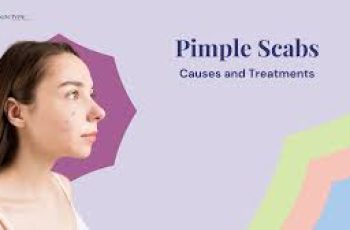 Pimple Scab: How to Heal Acne Scabs