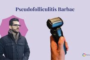 Pseudofolliculitis Barbae Prevention and Treatments