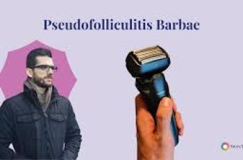 Pseudofolliculitis Barbae Prevention and Treatments