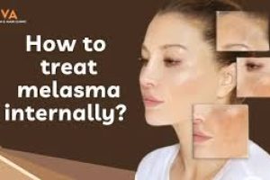 How To Treat Melasma From The Inside