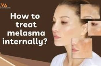 How To Treat Melasma From The Inside