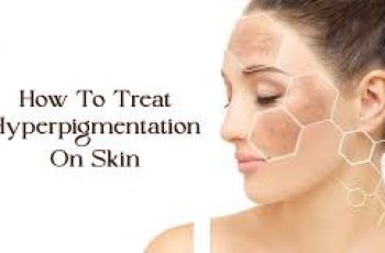 How to Treat Hyperpigmentation