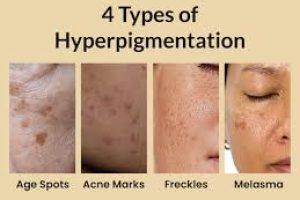 Skin Hyperpigmentation: Types and Causes