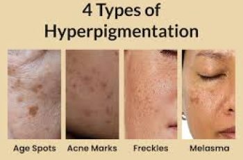 Skin Hyperpigmentation: Types and Causes