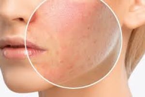 Skin Care Ingredients That Cause Allergic Reactions on the Face