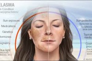 How To Get Rid of Melasma