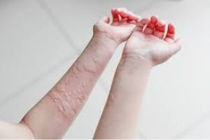 What is A Skin Allergy?