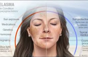 What is Melasma?